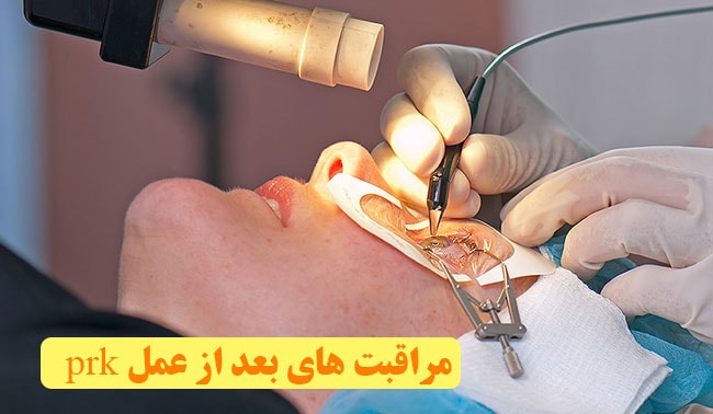 مراقبت های بعد از عمل prk