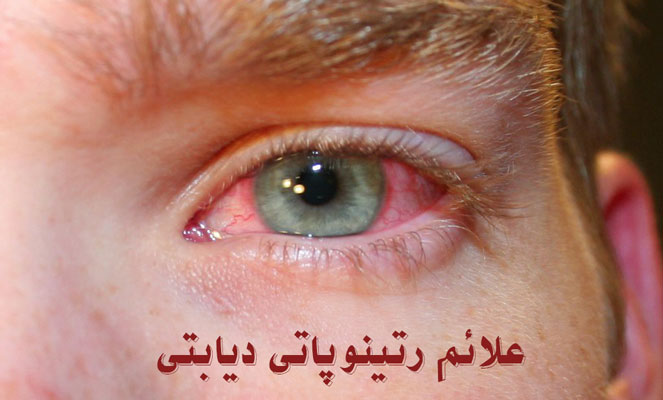 علائم رتینوپاتی دیابتی