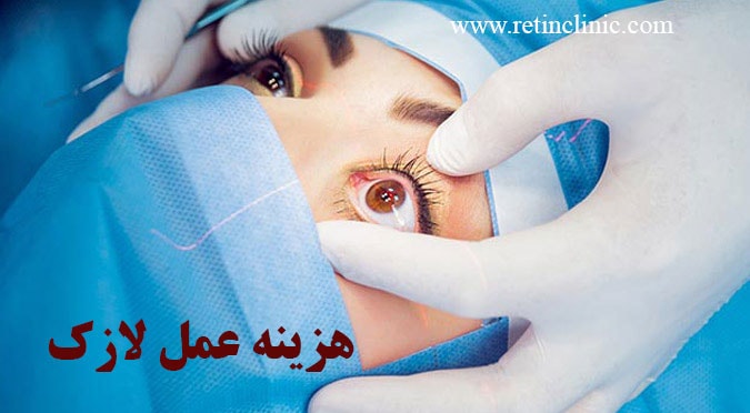 هزینه عمل لازک چشم