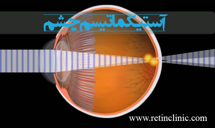 آستیگمات یا آستیگماتیسم