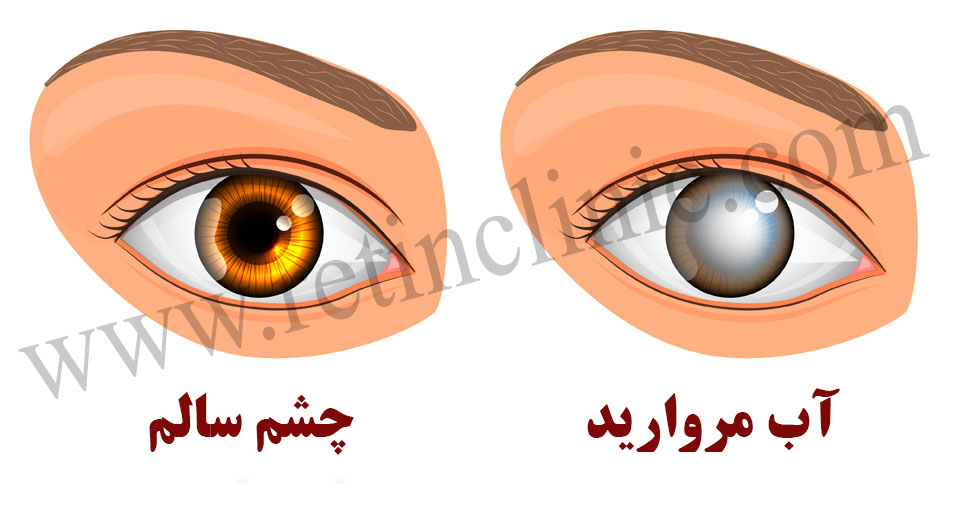 آب مروارید