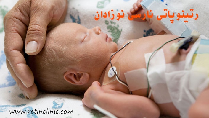 رتینوپاتی نارسی نوزادان