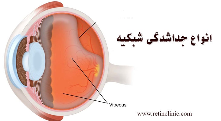 انواع جدا شدگی پرده شبکیه