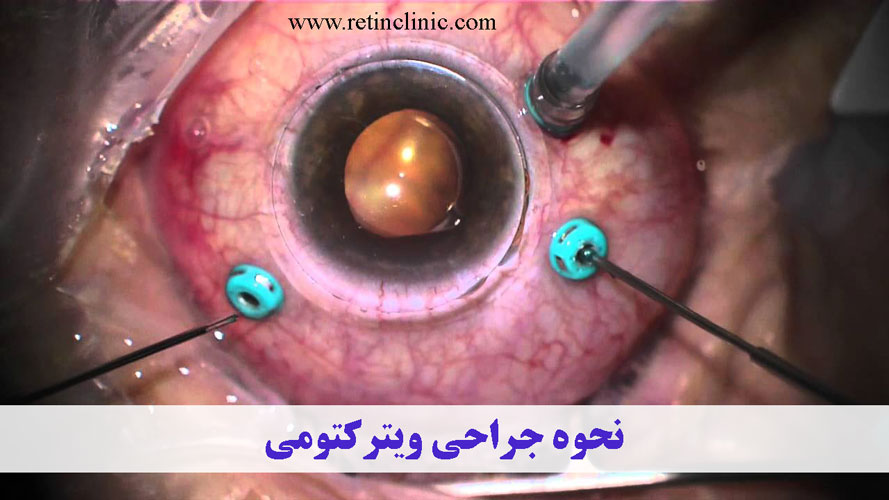 نحوه جراحی ویترکتومی
