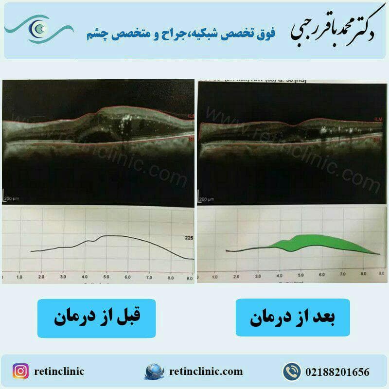 درمان ورم شبکیه ناشی از دیابت