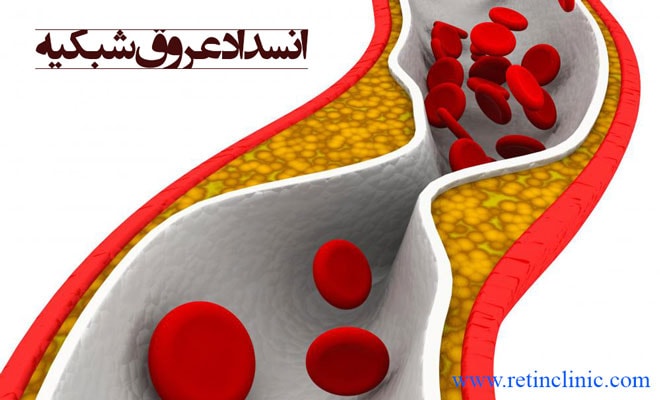 انسداد عروق شبکیه