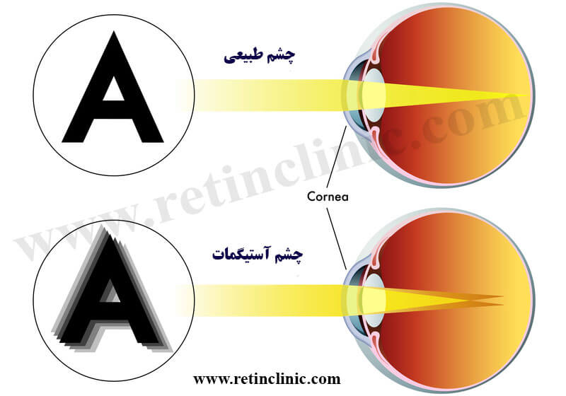 آستیگماتیسم چشم