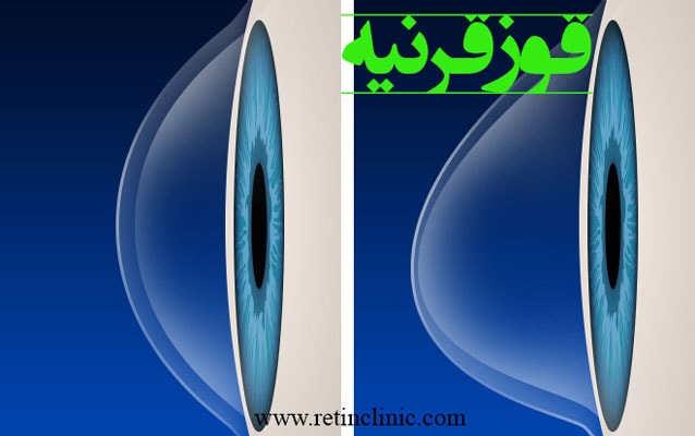 کراتوکونوس یا قوز قرنیه