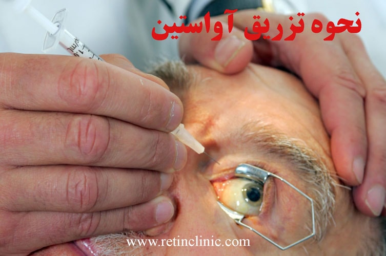 نحوه تزریق آواستین