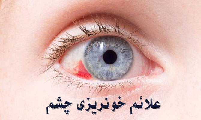 علائم خونریزی چشم