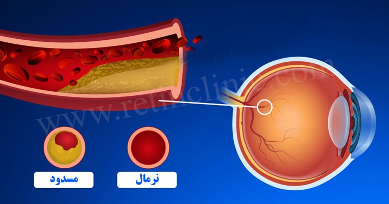 انسداد عروق شبکیه