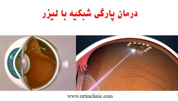 درمان پارگی شبکیه با لیزر