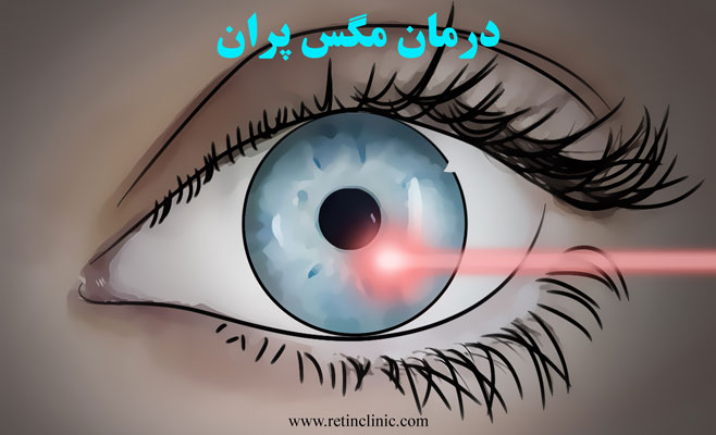درمان مگس پران چشم