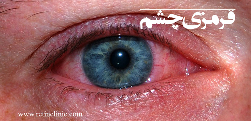 قرمزی چشم