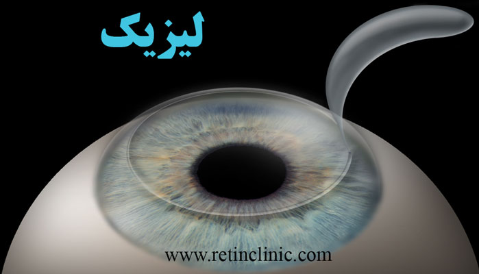 لیزیک