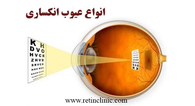 عیوب انکساری