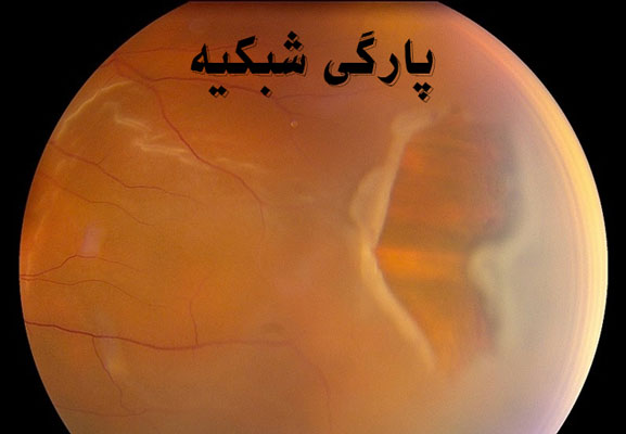پارگی شبکیه