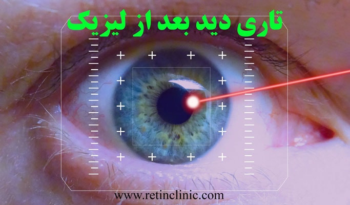 تاری دید بعد از لیزیک