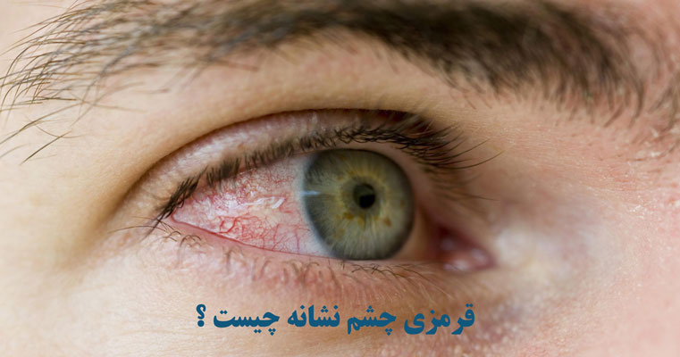 قرمزی چشم نشانه چیست ؟