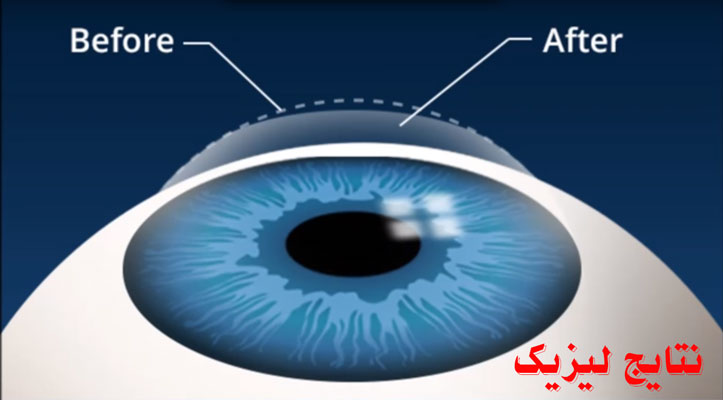 نتایج لیزیک