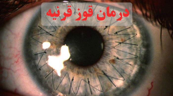 درمان قوز قرنیه
