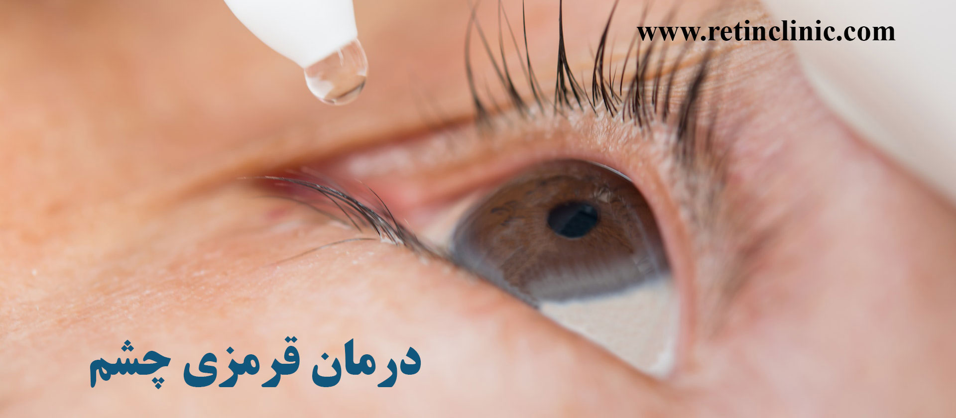 درمان قرمزی چشم