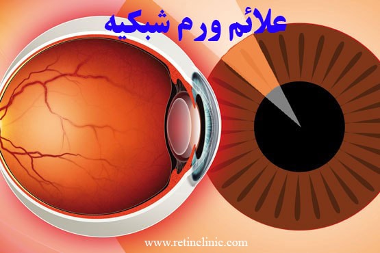 علائم ورم شبکیه