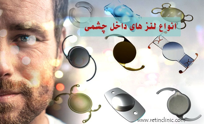 انواع لنز داخل چشمی