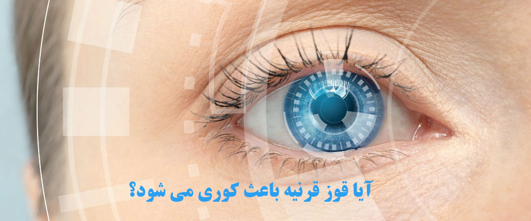 ایا قوز قرنیه باعث کوری میشود ؟