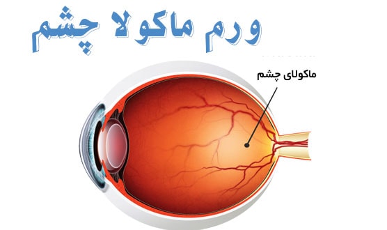 ورم ماکولا چشم