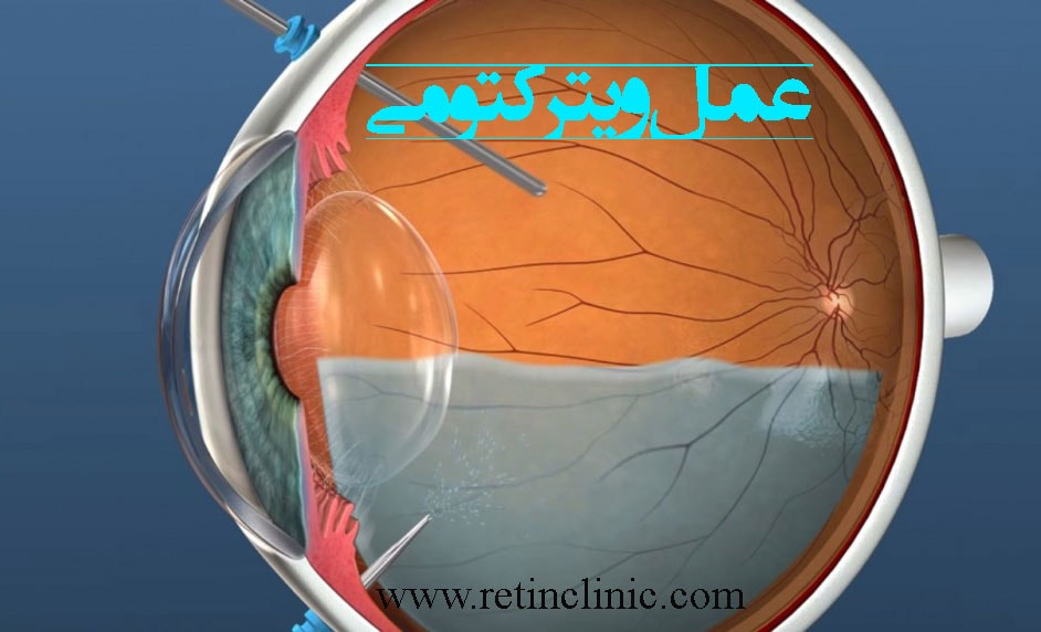 عمل ویترکتومی