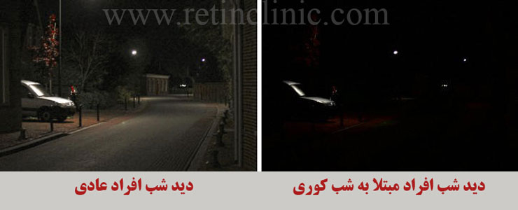 شب کوری