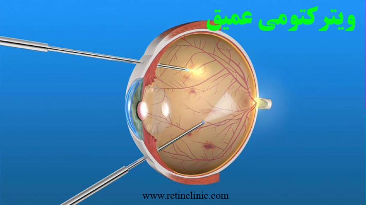 ویترکتومی عمیق