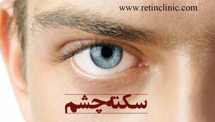 سکته چشم